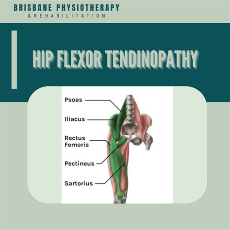 Hip Flexor Tendinopathy - What is it? Causes, Symptoms, Diagnosis & Physio - Brisbane ...
