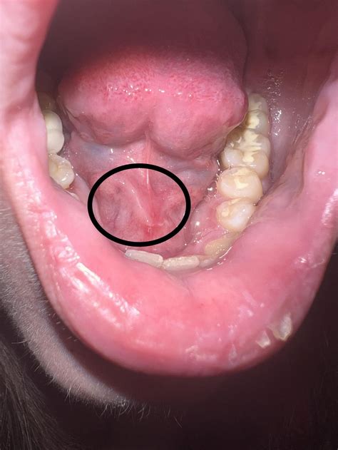 Skin/Tag, Bubble, Bump under tongue : r/medical_advice