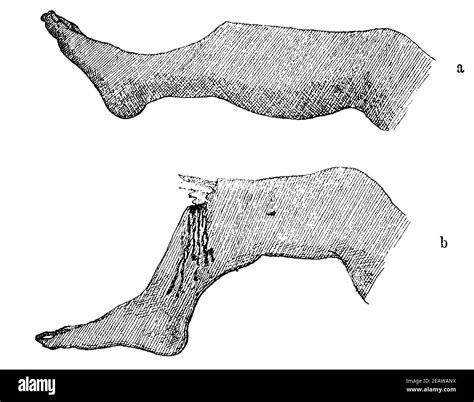 Open fracture hi-res stock photography and images - Alamy