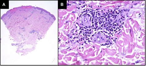 Cutaneous skin manifestation following messenger RNA Moderna SARS-CoV-2 ...