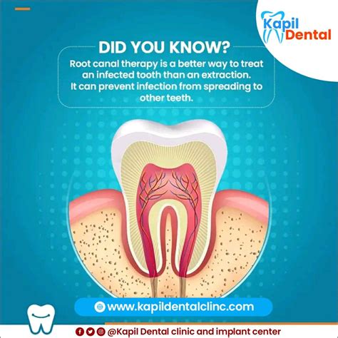 RCT- Relieving Tooth Pain Restoring Your Smile | Dental clinic, Tooth pain, Dental