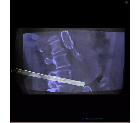 Philips - XperGuide - Live 3D needle guidance - Philips