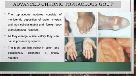 Gouty arthritis | PPTX