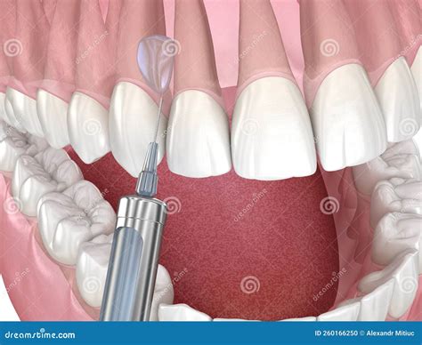 Local Anesthesia Cartoon 的图像结果