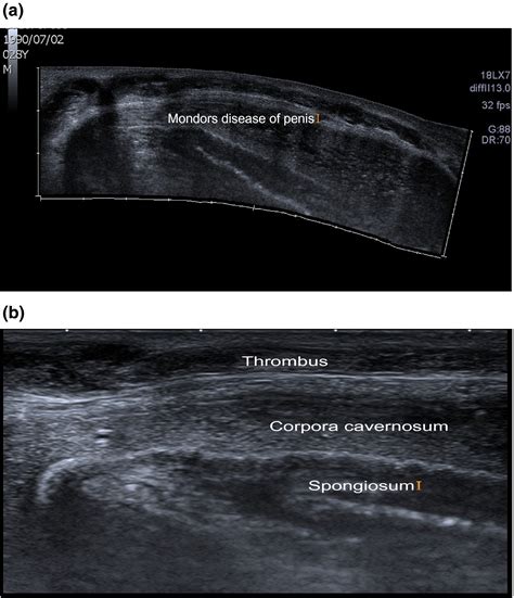 Penile Mondor’s disease: Clinical and sonographic images - Mukendi ...