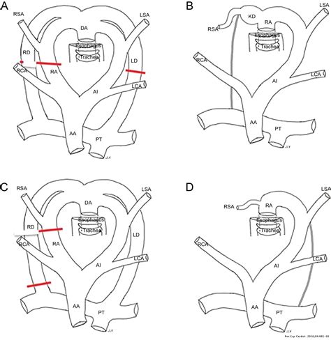 Right Aortic Arch With Aberrant Left Subclavian