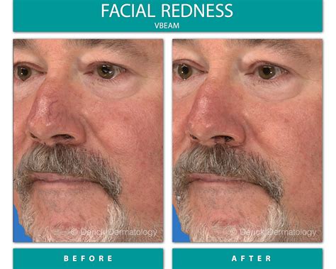 Before & After Gallery - Facial Redness - VBeam - Derick Dermatology