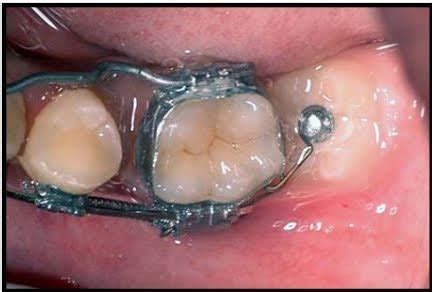 Latest News & Updates in Dentistry: Which is Best Crown down, New ...
