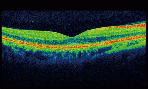 Macular Optical Coherence Tomography