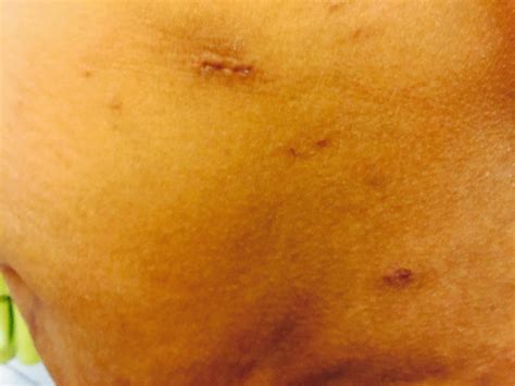 My Belly Button Hernia Umbilical Hernia Repair surgery: My Belly Button Umbilical Hernia With ...