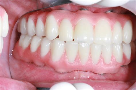 Full Dental Implants