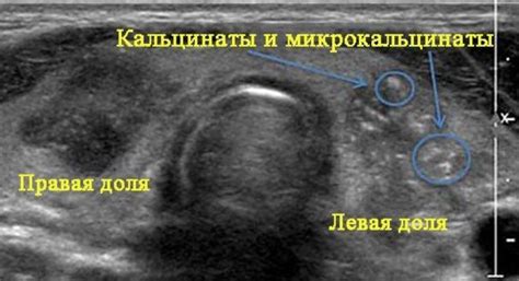 Кальцинаты в почках: что это такое, причины появления, симптомы ...