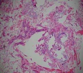 Abdominal calcification - is it meconium peritonitis? | Pediatric ...