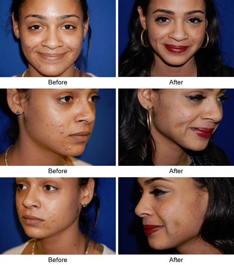 Dimple Surgery Dimple Creation Surgery/ Dimpleplasty