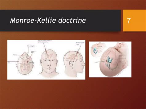 Monro Kellie Doctrine