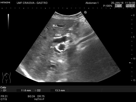 Endoscopic Ultrasound Dilated Bile Duct at Joseph Shupe blog