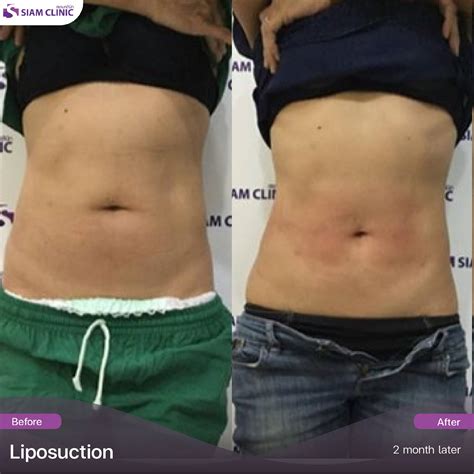 Liposuction Before and After Photos - Siam Clinic Thailand