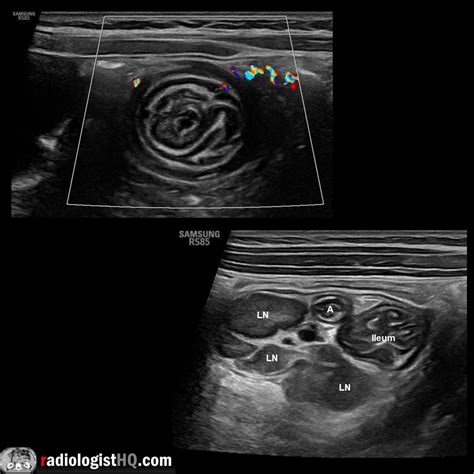 Ultrasound of ileocolic intussusception : r/Radiology