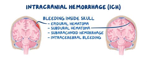 Epidural Subdural Subarachnoid Hemorrhage Google Search Acute Epidural