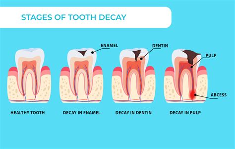 Study Suggests Combined Use Of Fluoride And Iodine Is Significantly More Effective In Preventing ...