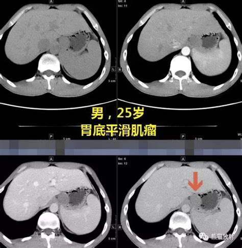 胃间质瘤和胃神经鞘瘤的CT鉴别诊断-MedSci.cn
