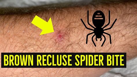 lyme disease 10 years after bite
