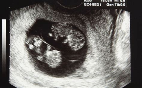 怀孕第13周双胞胎B超图_胎儿生长发育_育儿_99健康网