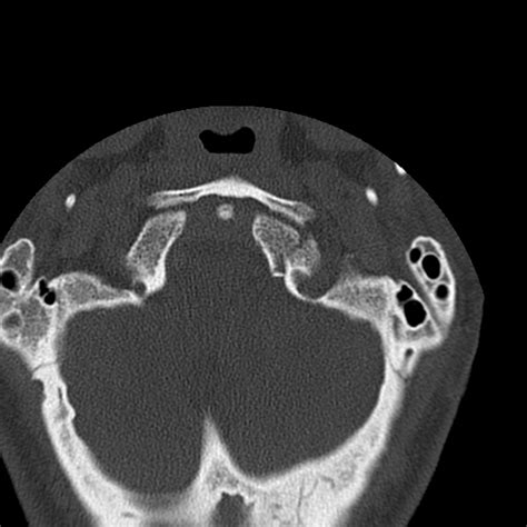Occipital condyle fracture (Radiopaedia 31755-32691 Axial bone window ...