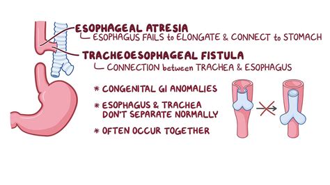 Proximal Vs Distal Esophagus