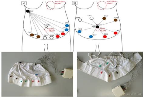 Antepartum Fetal Monitoring through a Wearable System and a Mobile ...