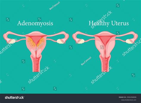 Anatomical Diagram Showing Adenomyosis Symptoms Versus Stock Vector (Royalty Free) 2591058009 ...