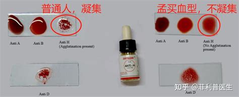 长沙发现一例「类孟买血型」，在中国极其罕见仅百余例，什么是类孟买血型？哪些信息值得关注？ - 知乎