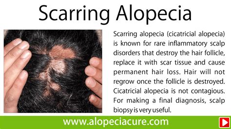 scarring alopecia treatment