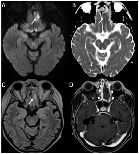 Neuroimaging of the Most Common Meningitis and Encephalitis of Adults ...