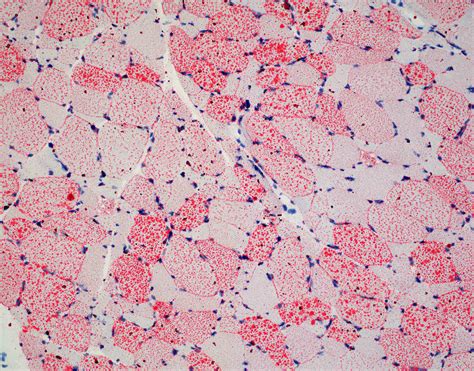 Pathology Outlines - Oil red O