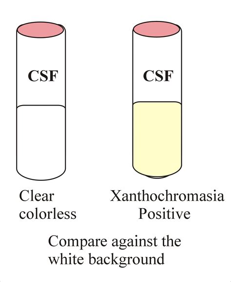 Cerebrospinal fluid Xanthochromia , (CSF) - Labpedia.net