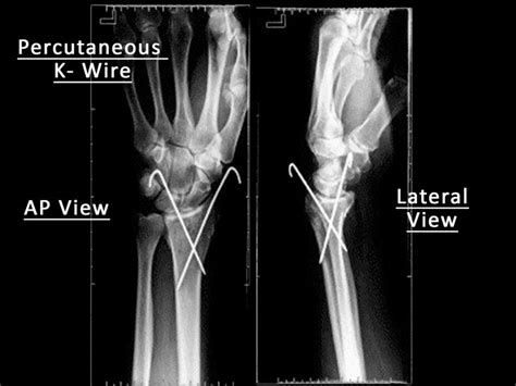 Distal End Radius Fractures - Colles, Smiths & Bartons | PPTX