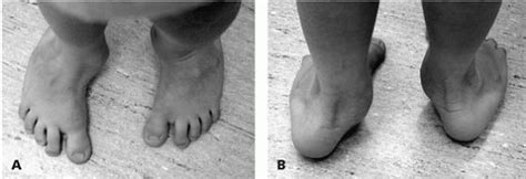 Foot Problems in Children - TeachMe Orthopedics