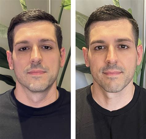 Gua Sha: Before And After - Can You Really See A Difference?