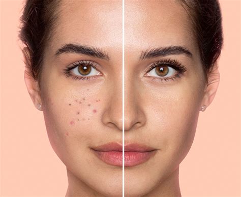 Scar Revision Procedure 的图像结果