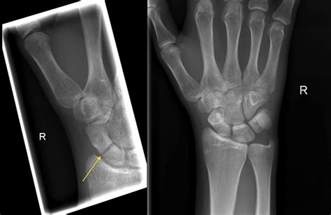Scaphoid Fracture X Ray