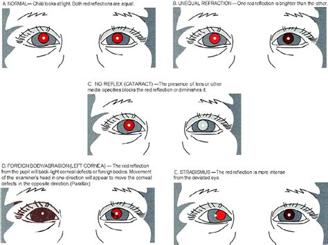 Pediatric Eye Evaluations Preferred Practice Pattern® - Ophthalmology