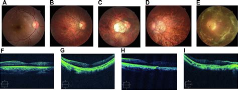 Genotype-phenotype Correlations of Ocular Posterior Segment ...