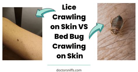 Lice vs Bed Bugs - Ultimate Guide with Photos
