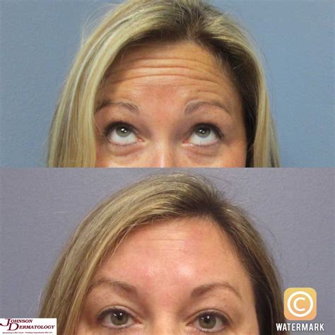 What Botox Looks Like After Years of Use, According to Derms
