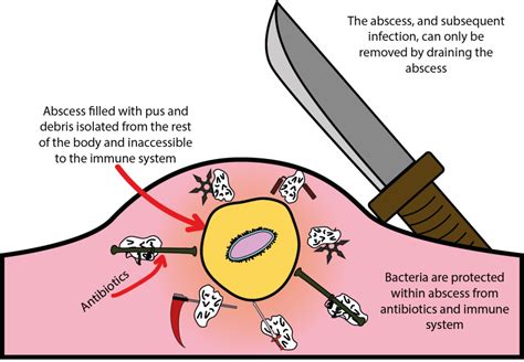 Infected Abscess Lanced 的图像结果