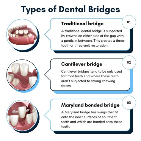 Cantilever Bridge Dental