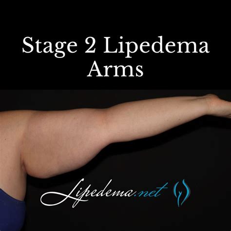 Upper Arm Edema