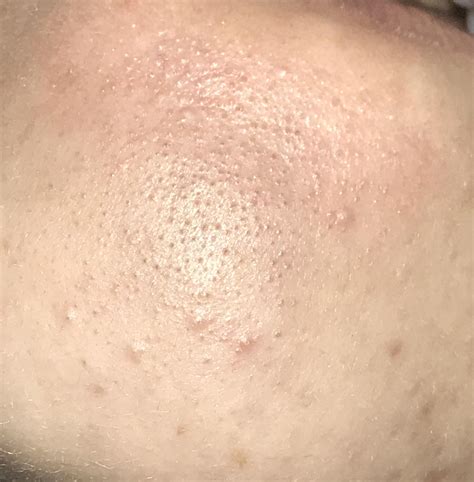 [acne] Can anyone suggest how to help clear this on my chin? Not sure if it’s sebaceous ...
