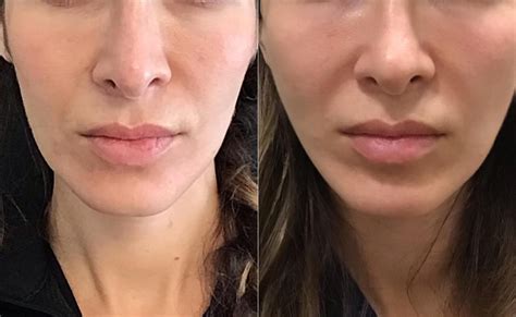 New Thread Lift 的图像结果